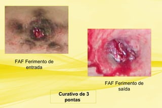 Curativo de 3
pontas
FAF Ferimento de
entrada
FAF Ferimento de
saída
 