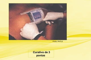 Curativo de 3
pontas
Fonte: PHTLS
 