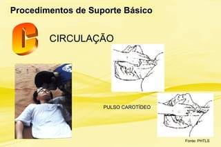 CIRCULAÇÃO
Procedimentos de Suporte Básico
PULSO CAROTÍDEO
Fonte: PHTLS
 