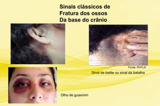 Fonte: PHTLS
Sinais clássicos de
Fratura dos ossos
Da base do crânio
Sinal de battle ou sinal da batalha
Olho de guaxinim
 