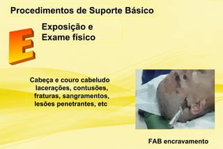 Procedimentos de Suporte Básico
Exposição e
Exame físico
Cabeça e couro cabeludo :
lacerações, contusões,
fraturas, sangramentos,
lesões penetrantes, etc
FAB encravamento
 