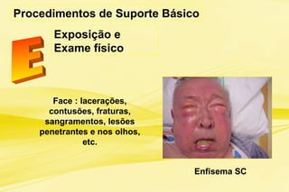 Procedimentos de Suporte Básico
Exposição e
Exame físico
Enfisema SC
Face : lacerações,
contusões, fraturas,
sangramentos, lesões
penetrantes e nos olhos,
etc.
 