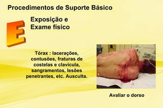 Procedimentos de Suporte Básico
Exposição e
Exame físico
Avaliar o dorso
Tórax : lacerações,
contusões, fraturas de
costelas e clavícula,
sangramentos, lesões
penetrantes, etc. Ausculta.
 