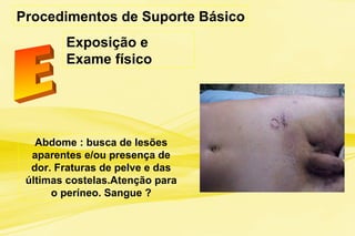 Procedimentos de Suporte Básico
Exposição e
Exame físico
Abdome : busca de lesões
aparentes e/ou presença de
dor. Fraturas de pelve e das
últimas costelas.Atenção para
o períneo. Sangue ?
 