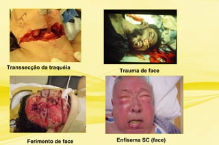 Enfisema SC (face)Ferimento de face
Transsecção da traquéia
Trauma de face
 