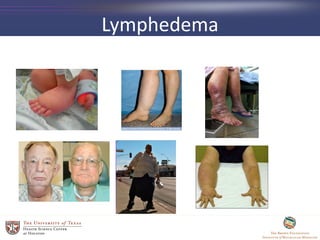 Lymphedema
 