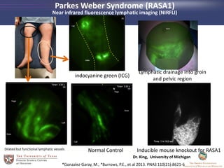 Dilated but functional lymphatic vessels Normal Control
Lymphatic drainage into groin
and pelvic region
*Gonzalez-Garay, M., *Burrows, P.E., et al 2013. PNAS 110(21):8621-6
Inducible mouse knockout for RASA1
indocyanine green (ICG)
Parkes Weber Syndrome (RASA1)
Near infrared fluorescence lymphatic imaging (NIRFLI)
Dr. King, University of Michigan
 