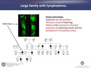 Large family with lymphedema.
Index Case
Unique phenotype
•Extensive dermal backflow
•Tortuous vessels in both legs
•Defect in the mechanism of lymph
propulsion in collecting vessels and the
development of lymphatic valves
 