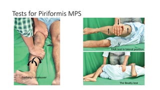 Tests for Piriformis MPS
Freiberg’s maneuver
FAIR test in lateral position
The Beatty test
 