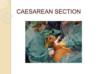 CAESAREAN SECTION
 