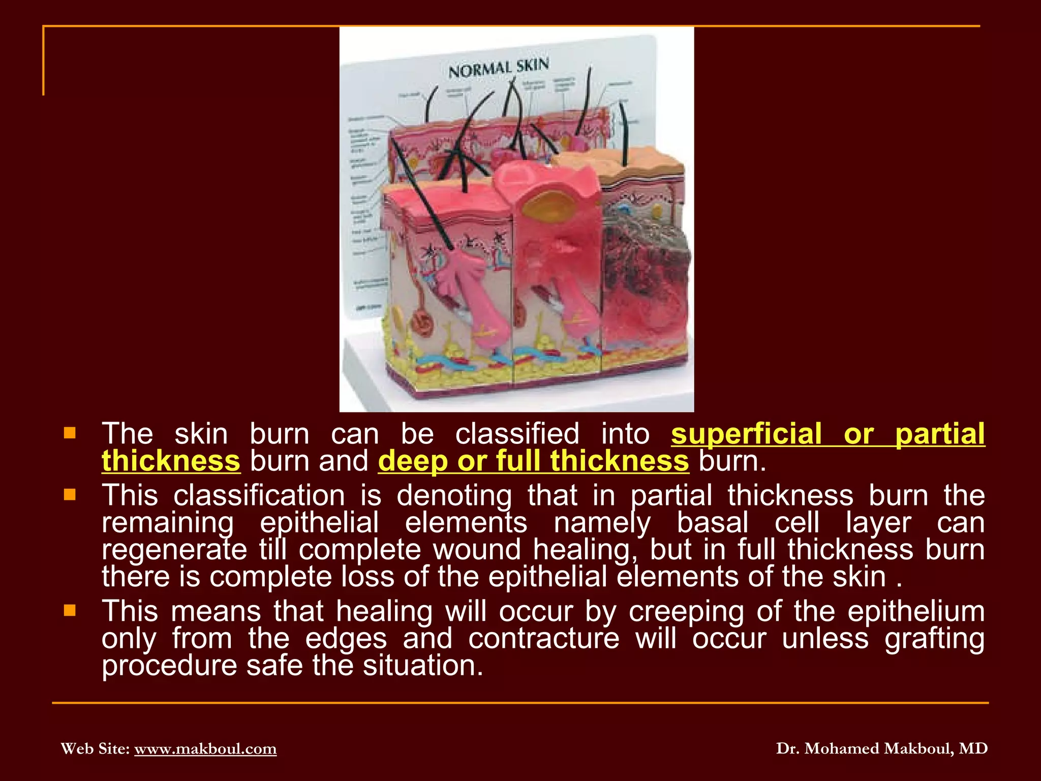 The skin burn can be classified into  superficial or partial thickness  burn and  deep or full thickness  burn.  This classification is denoting that in partial thickness burn the remaining epithelial elements namely basal cell layer can regenerate till complete wound healing, but in full thickness burn there is complete loss of the epithelial elements of the skin . This means that healing will occur by creeping of the epithelium only from the edges and contracture will occur unless grafting procedure safe the situation.  