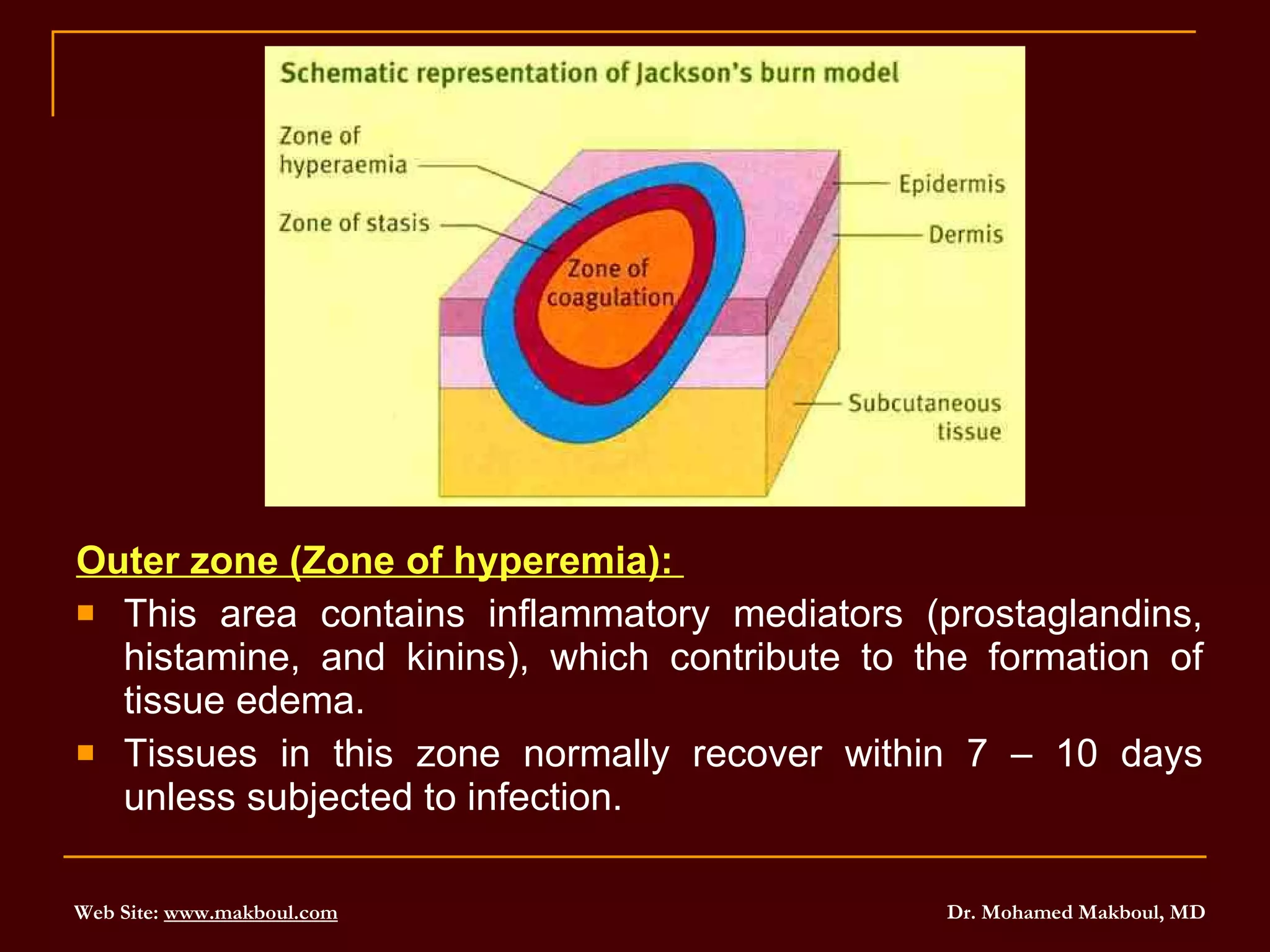 Outer zone (Zone of hyperemia):   This area contains inflammatory mediators (prostaglandins, histamine, and kinins), which contribute to the formation of tissue edema.  Tissues in this zone normally recover within 7 – 10 days unless subjected to infection. 
