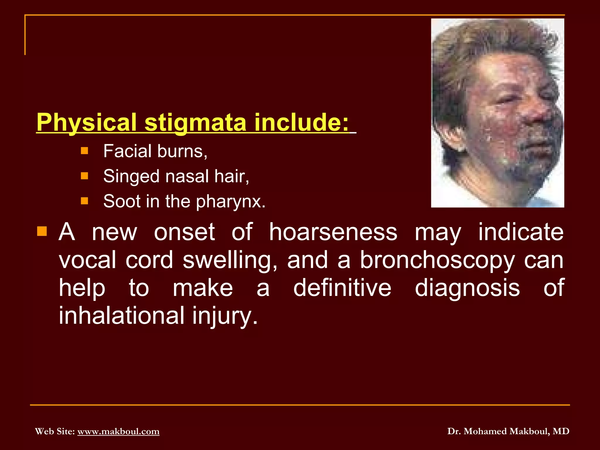 Physical stigmata include:   Facial burns,  Singed nasal hair, Soot in the pharynx.  A new onset of hoarseness may indicate vocal cord swelling, and a bronchoscopy can help to make a definitive diagnosis of inhalational injury.  
