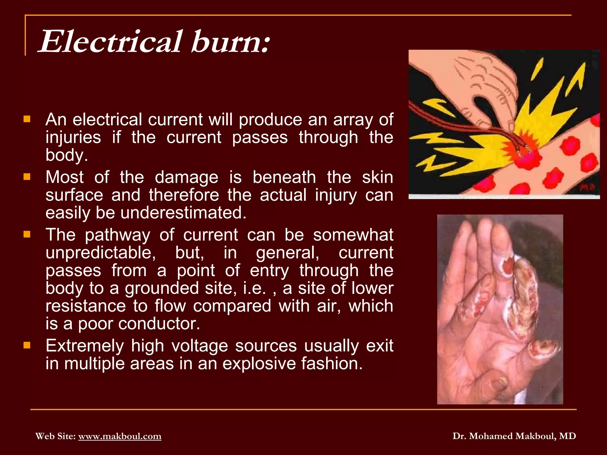 Electrical burn: An electrical current will produce an array of injuries if the current passes through the body.  Most of the damage is beneath the skin surface and therefore the actual injury can easily be underestimated.  The pathway of current can be somewhat unpredictable, but, in general, current passes from a point of entry through the body to a grounded site, i.e. , a site of lower resistance to flow compared with air, which is a poor conductor.  Extremely high voltage sources usually exit in multiple areas in an explosive fashion.  