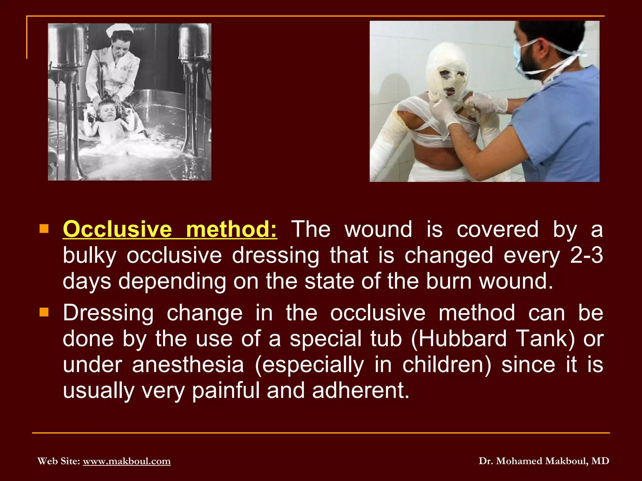 Occlusive method:  The wound is covered by a bulky occlusive dressing that is changed every 2-3 days depending on the state of the burn wound. Dressing change in the occlusive method can be done by the use of a special tub (Hubbard Tank) or under anesthesia (especially in children) since it is usually very painful and adherent. 