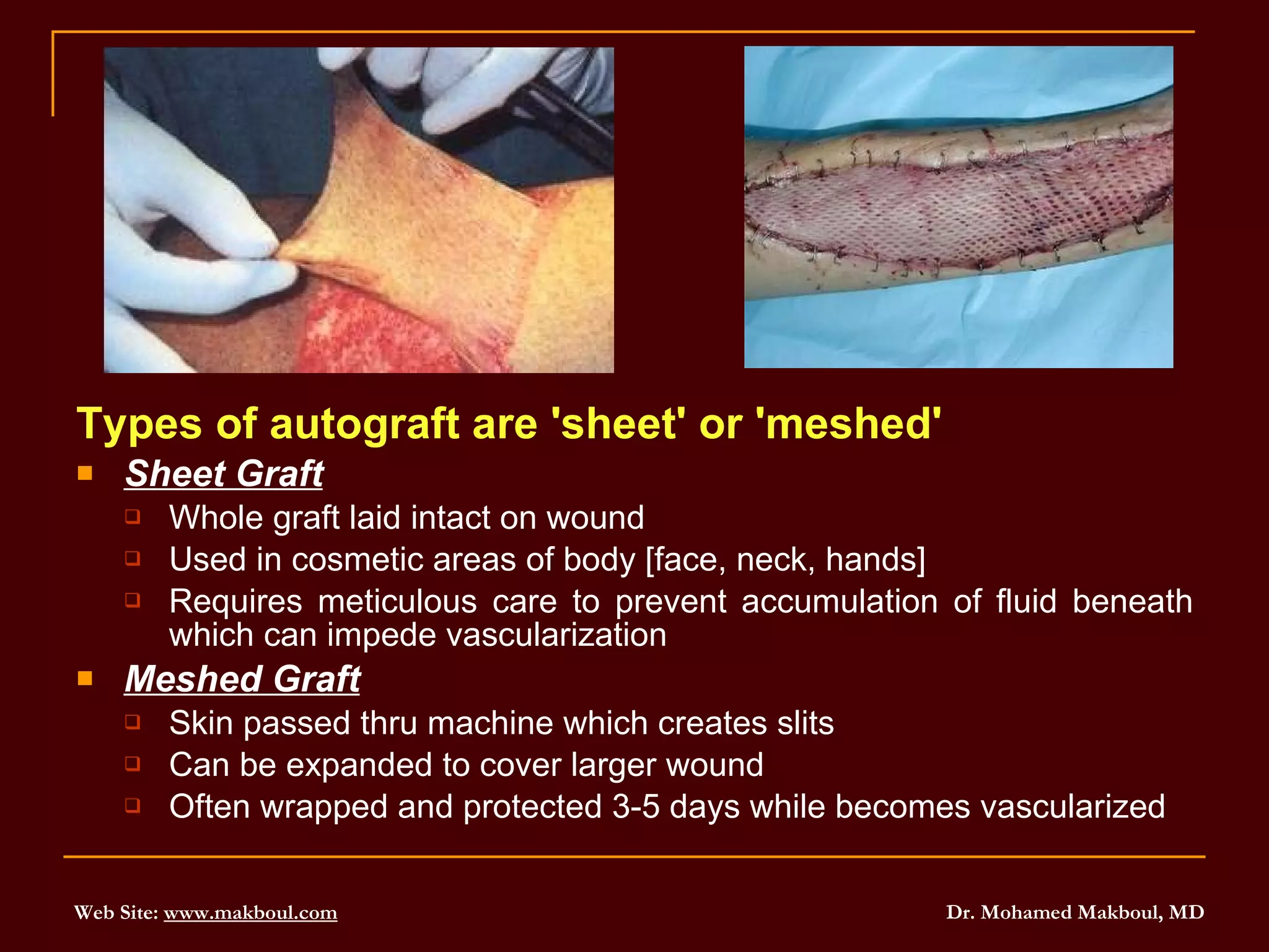 Types of autograft are 'sheet' or 'meshed' Sheet Graft Whole graft laid intact on wound Used in cosmetic areas of body [face, neck, hands] Requires meticulous care to prevent accumulation of fluid beneath which can impede vascularization Meshed Graft Skin passed thru machine which creates slits Can be expanded to cover larger wound Often wrapped and protected 3-5 days while becomes vascularized 