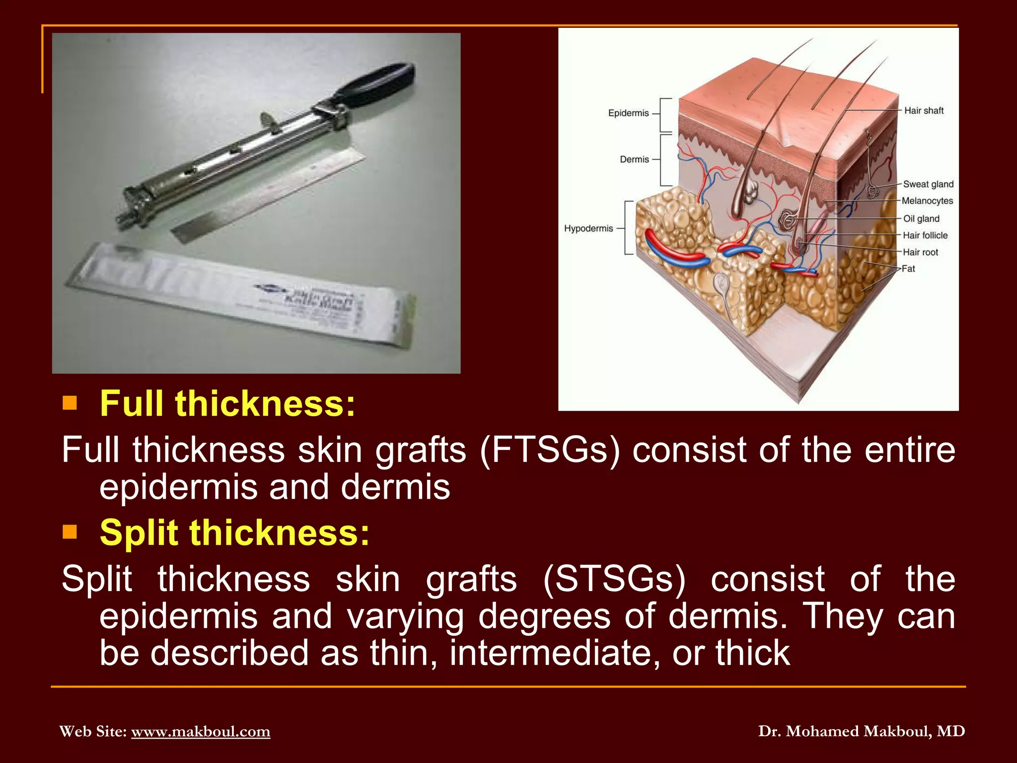 Full thickness: Full thickness skin grafts (FTSGs) consist of the entire epidermis and dermis Split thickness: Split thickness skin grafts (STSGs) consist of the epidermis and varying degrees of dermis. They can be described as thin, intermediate, or thick 