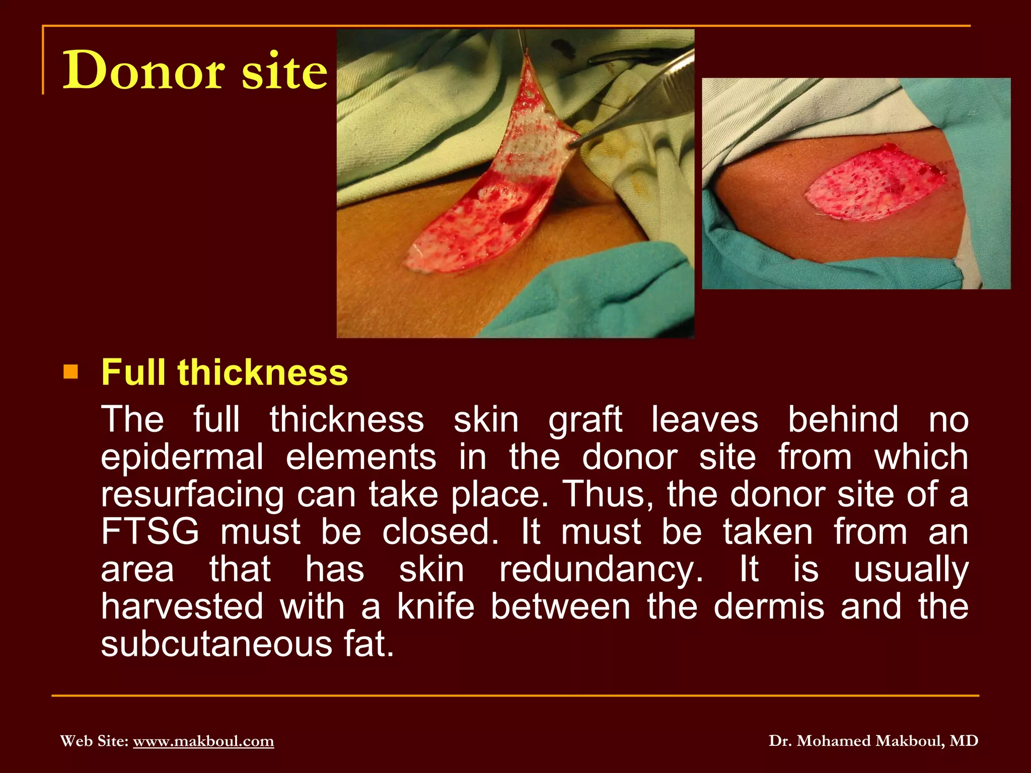 Donor site Full thickness The full thickness skin graft leaves behind no epidermal elements in the donor site from which resurfacing can take place. Thus, the donor site of a FTSG must be closed. It must be taken from an area that has skin redundancy. It is usually harvested with a knife between the dermis and the subcutaneous fat. 