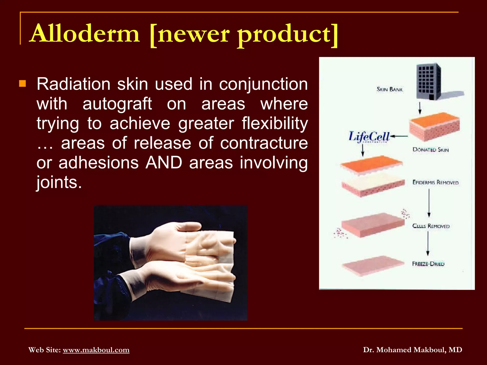 Alloderm [newer product] Radiation skin used in conjunction with autograft on areas where trying to achieve greater flexibility … areas of release of contracture or adhesions AND areas involving joints. 