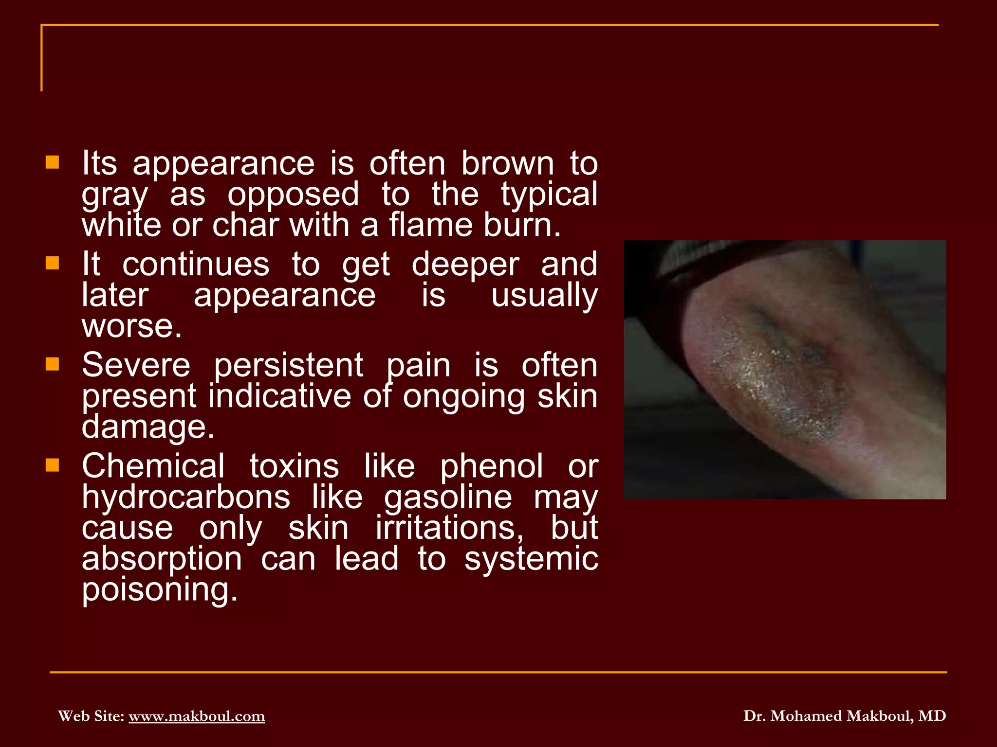 Its appearance is often brown to gray as opposed to the typical white or char with a flame burn.  It continues to get deeper and later appearance is usually worse.  Severe persistent pain is often present indicative of ongoing skin damage.  Chemical toxins like phenol or hydrocarbons like gasoline may cause only skin irritations, but absorption can lead to systemic poisoning. 