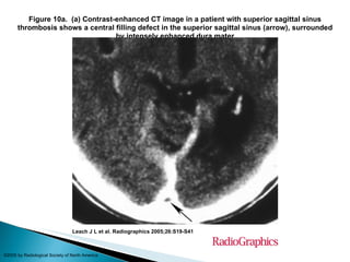 Figure 10a.  (a) Contrast-enhanced CT image in a patient with superior sagittal sinus thrombosis shows a central filling defect in the superior sagittal sinus (arrow), surrounded by intensely enhanced dura mater Leach J L et al. Radiographics 2005;26:S19-S41 ©2005 by Radiological Society of North America 