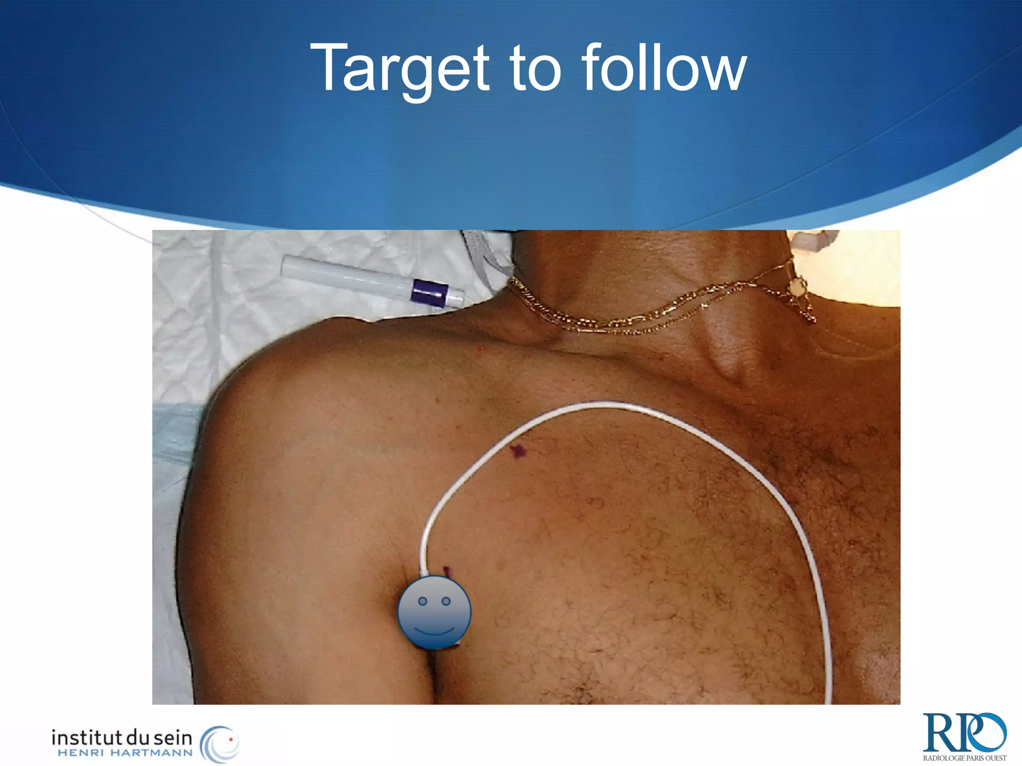 Catheter tip positioning control in chest port implantation. Luc ...