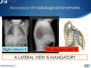 Catheter tip positioning control in chest port implantation. Luc ...