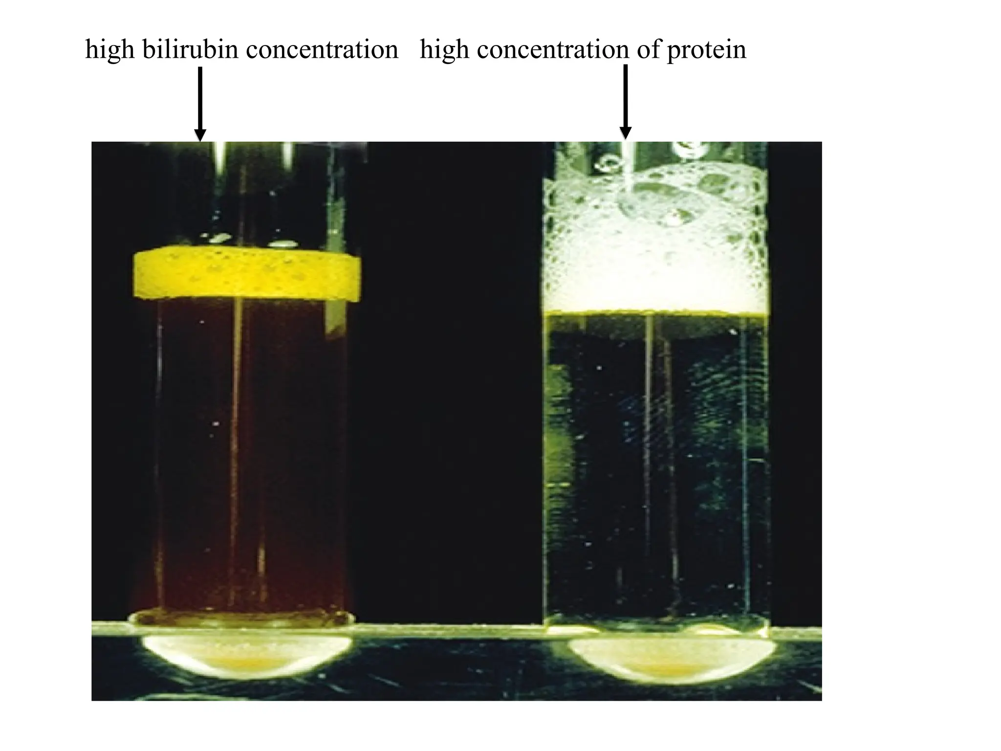 high bilirubin concentration high concentration of protein
 