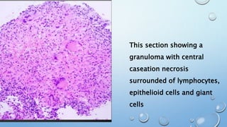 Caseation Hitopath CHRONIC INFLAMMATION | PPTX