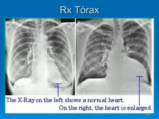 Rx Tórax 