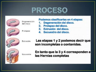 Localización más frecuente: Cervical C5-C6 y C6-C7, y Lumbar L4-L5 y L5-S1Lumbalgia en adultos el 1-2% de   éstos es causado por una hernia discalPuede comprimir varias ramas de todo el conducto dural.Puede comprimir una rama en el agujero de conjunción.Puede comprimir una rama de la salida de la médula espinal ó  de la cola de caballo.