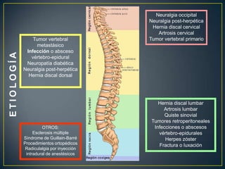 ETIOLOGÍANeuralgia occipitalNeuralgia post-herpéticaHernia discal cervicalArtrosis cervicalTumor vertebral primarioTumor vertebral metastásicoInfección o absceso vértebro-epiduralNeuropatía diabéticaNeuralgia post-herpéticaHernia discal dorsalHernia discal lumbarArtrosis lumbarQuiste sinovialTumores retroperitonealesInfecciones o abscesos vértebro-epiduralesHerpes zósterFractura o luxaciónOTROS:Esclerosis múltipleSíndrome de Guillain-BarréProcedimientos ortopédicos Radiculalgia por inyección intradural de anestésicos