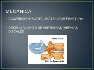 MECÁNICACOMPRESIÓN POSTRAUMÁTICA POR FRACTURADESPLAZAMIENTO DE VERTEBRAS (HERNIAS DISCALES