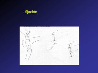 - fijación
 