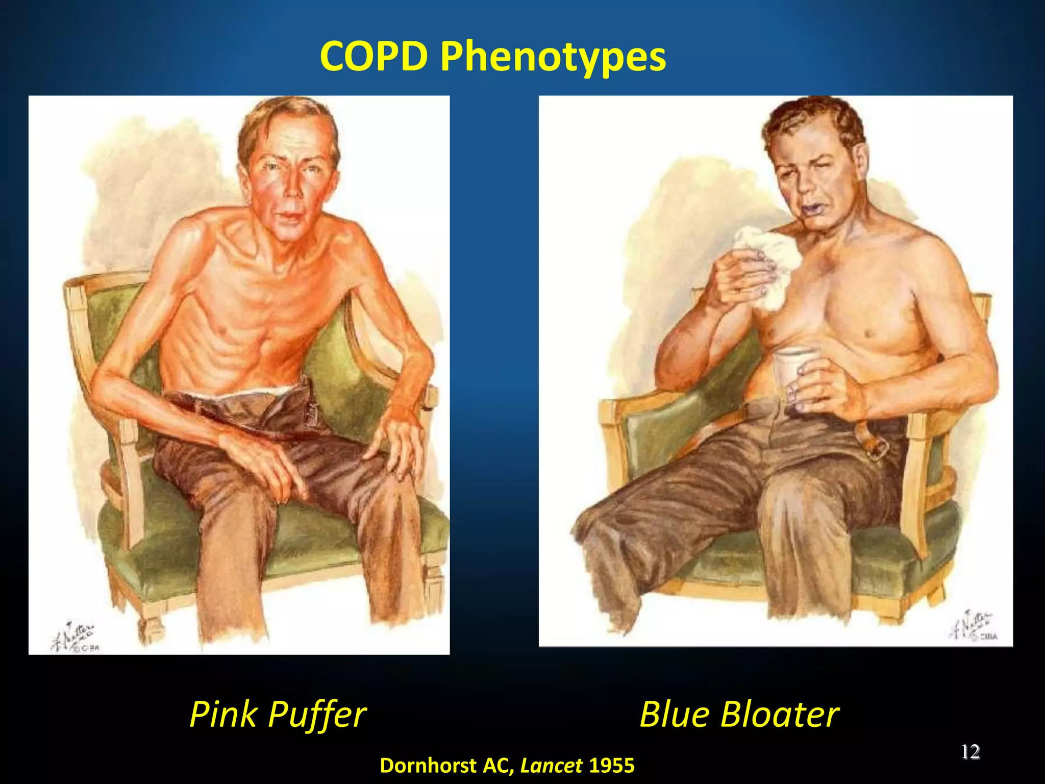 Pink Puffer Blue Bloater
COPD Phenotypes
Dornhorst AC, Lancet 1955
12
 
