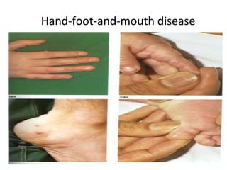 Hand-foot-and-mouth disease
 