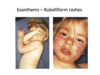 Exanthems – Rubelliform rashes
 