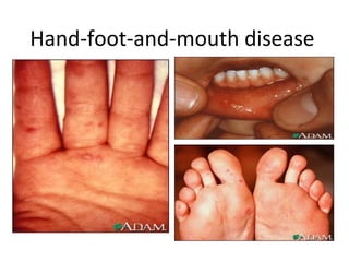 Hand-foot-and-mouth disease
 