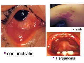 • rash
 conjunctivitis
 Herpangina
 