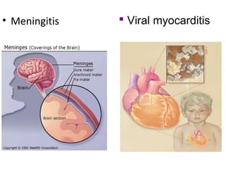 • Meningitis  Viral myocarditis
 
