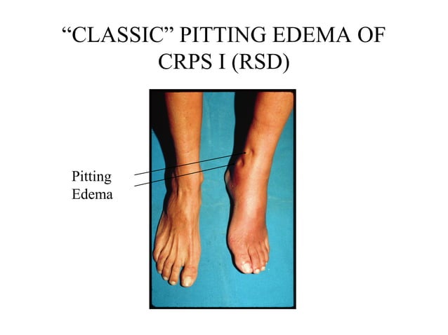 CRPS I (RSD) with pictures. Differential Diagnosis | PPT