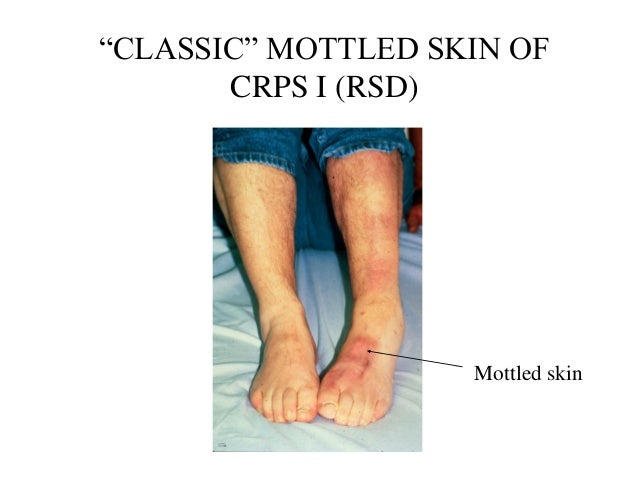 crps pictures