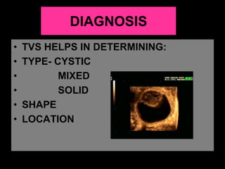 DIAGNOSIS
• TVS HELPS IN DETERMINING:
• TYPE- CYSTIC
• MIXED
• SOLID
• SHAPE
• LOCATION
 