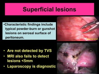 Superficial lesions
• Are not detected by TVS
• MRI also fails to detect
lesions <5mm
• Laparoscopy is diagnostic
•Charact...