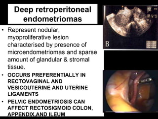 Deep retroperitoneal
endometriomas
• Represent nodular,
myoproliferative lesion
characterised by presence of
microendometr...