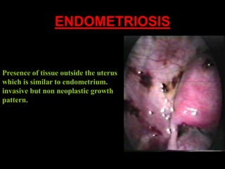 ENDOMETRIOSIS
Presence of tissue outside the uterus
which is similar to endometrium.
invasive but non neoplastic growth
pa...