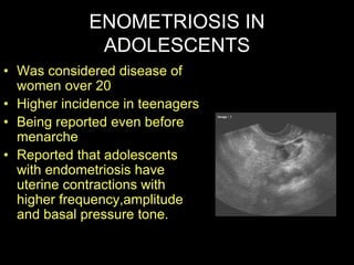 ENOMETRIOSIS IN
ADOLESCENTS
• Was considered disease of
women over 20
• Higher incidence in teenagers
• Being reported eve...
