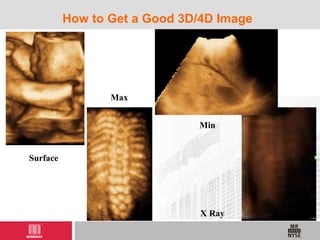 How to Get a Good 3D/4D Image
Surface
Max
Min
X Ray
 