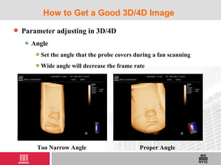 Parameter adjusting in 3D/4D
Angle
Set the angle that the probe covers during a fan scanning
Wide angle will decrease the frame rate
How to Get a Good 3D/4D Image
Too Narrow Angle Proper Angle
 