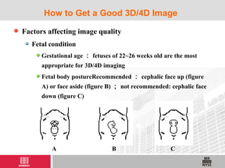 Factors affecting image quality
Fetal condition
Gestational age ： fetuses of 22~26 weeks old are the most
appropriate for 3D/4D imaging
Fetal body postureRecommended ： cephalic face up (figure
A) or face aside (figure B) ； not recommended: cephalic face
down (figure C)
How to Get a Good 3D/4D Image
A B C
 